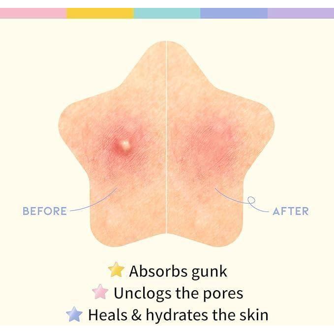 30 Pcs Pimple Patches